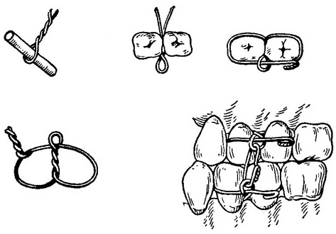 межчелюстное лігатурне скріплення за Айві