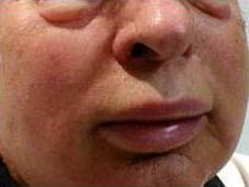 набряк Квінке