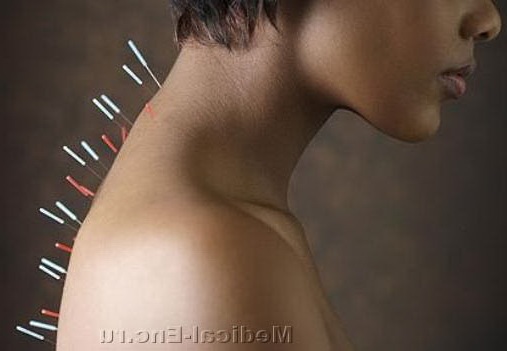 голкотерапія