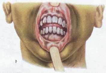 аддісонова хвороба