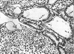 аденома околощитовидной залози
