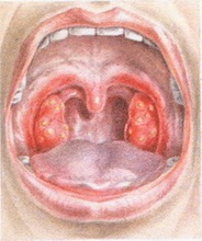 аденома сальних залоз Прінгл