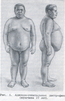 адипозо-генітальна дистрофія