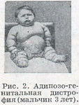 адипозо-генітальна дистрофія у дітей