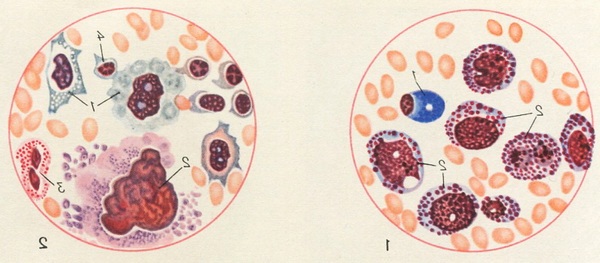 кістковий мозок при агранулоцитозі