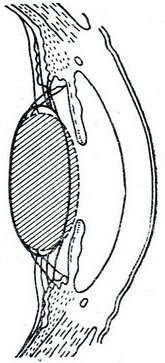 схема акомодації ока