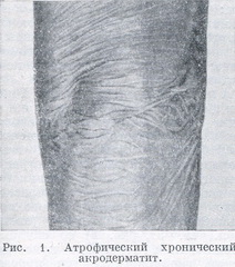 атрофічний хронічний акродерматит