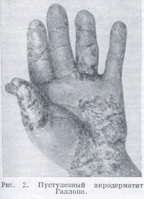пустульозний акродерматит Галлопо