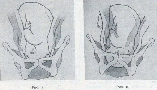 Визначення вставляння голівки