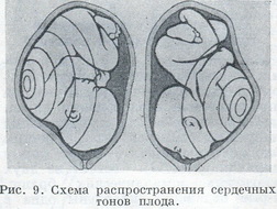 Схема поширення серцевих тонів плоду
