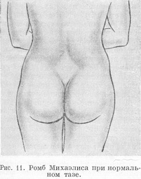 ромб Міхаеліса при нормальному тазі
