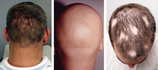 alopecia облисіння плішивість