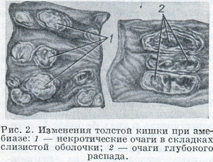 зміни товстої кишки при амебіазі