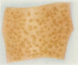 амілоїдоз шкіри