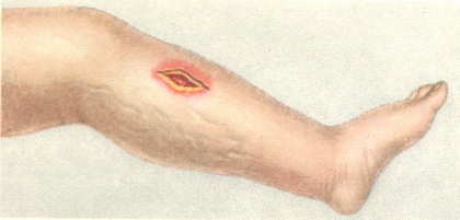 анаеробна інфекція гомілки