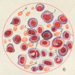 кістковий мозок при перніциозної анемії