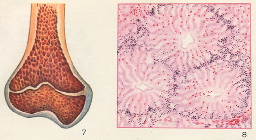 мієлоїдна гіперплазія кісткового мозку