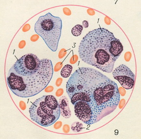 метастатичні ракові клітини в костномозговой пунктаті
