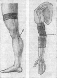 внутрішньовенна та внутрішньо-кісткова анестезія