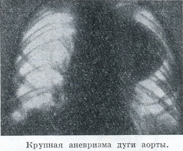велика аневризма дуги аорти