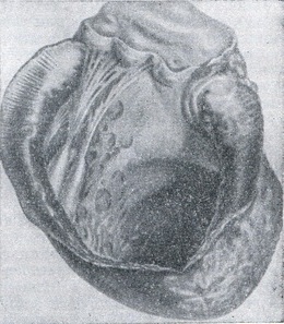 Аневризма серця