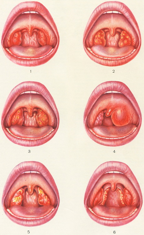 ангіна фото