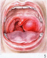 Флегмонозна ангіна