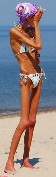 анорексія фото