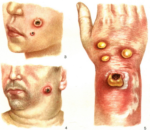 сибірська виразка anthrax