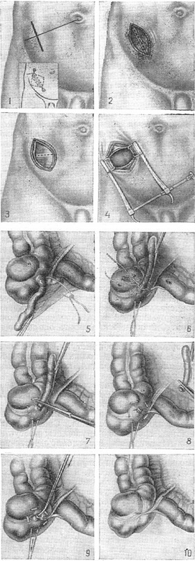 апендектомія