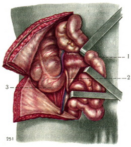 спадний положення червоподібного відростка