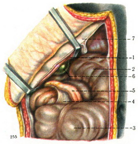 високе положення сліпої кишки і червоподібного відростка