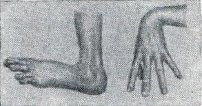 кисть і стопа при арахнодактилии