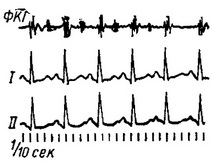 синусова тахікардія