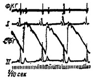 синусова брадикардія