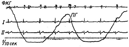 синусова (дихальна) аритмія