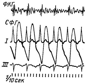 атріовентрикулярний ритм