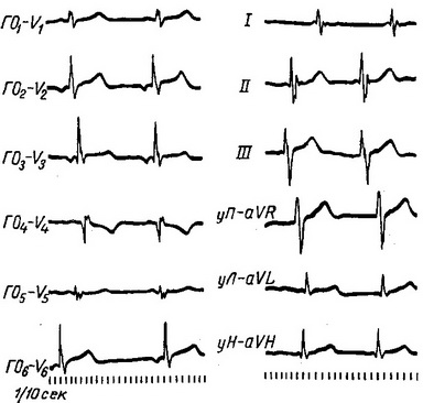 ритм вінцевої пазухи коронарного синуса