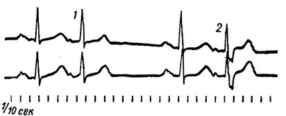 екстрасистолія