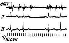 передсердні екстрасистоли