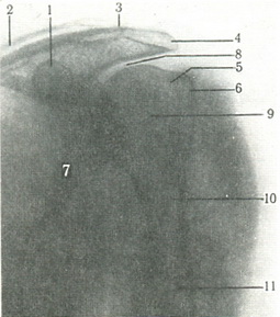 рентгенограма в задній проекції лівого плечового суглобу