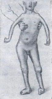 артрогрипоз