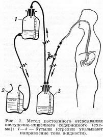 Метод постійного відсмоктування шлунково-кишкового вмісту