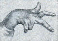 атетоз пальців руки