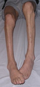 атрофія м'язів