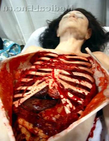 розтин трупа жінки (аутопсія)