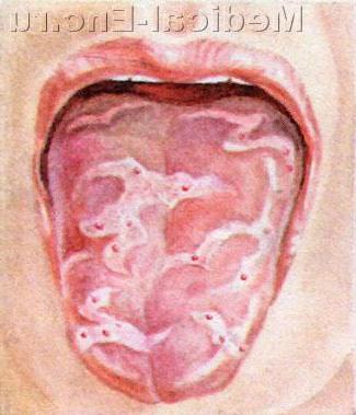 десквамативний глосит (географічний язик)