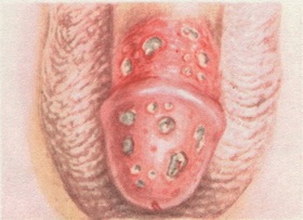 гангренозний баланопостит