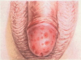 трихомонадний баланопостит