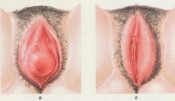 бартолініт